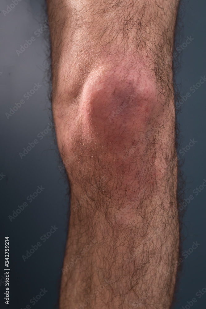 Naklejka premium The hairy knee on a dark background. Medical concept.