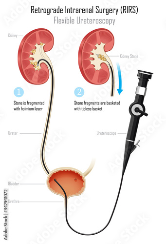 kidney stone treatment with flexible Ureteroscope
