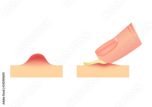 pus / popped pimple with finger vector