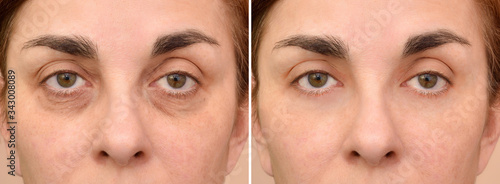 Female eye bags before and after cosmetic treatment or plastic procedure, blepharoplasty. Close-up.