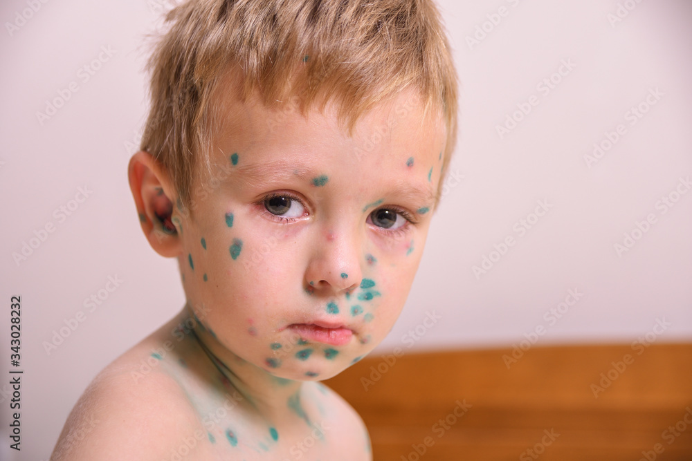Young toddler,boy with chickenpox. Sick child with chickenpox