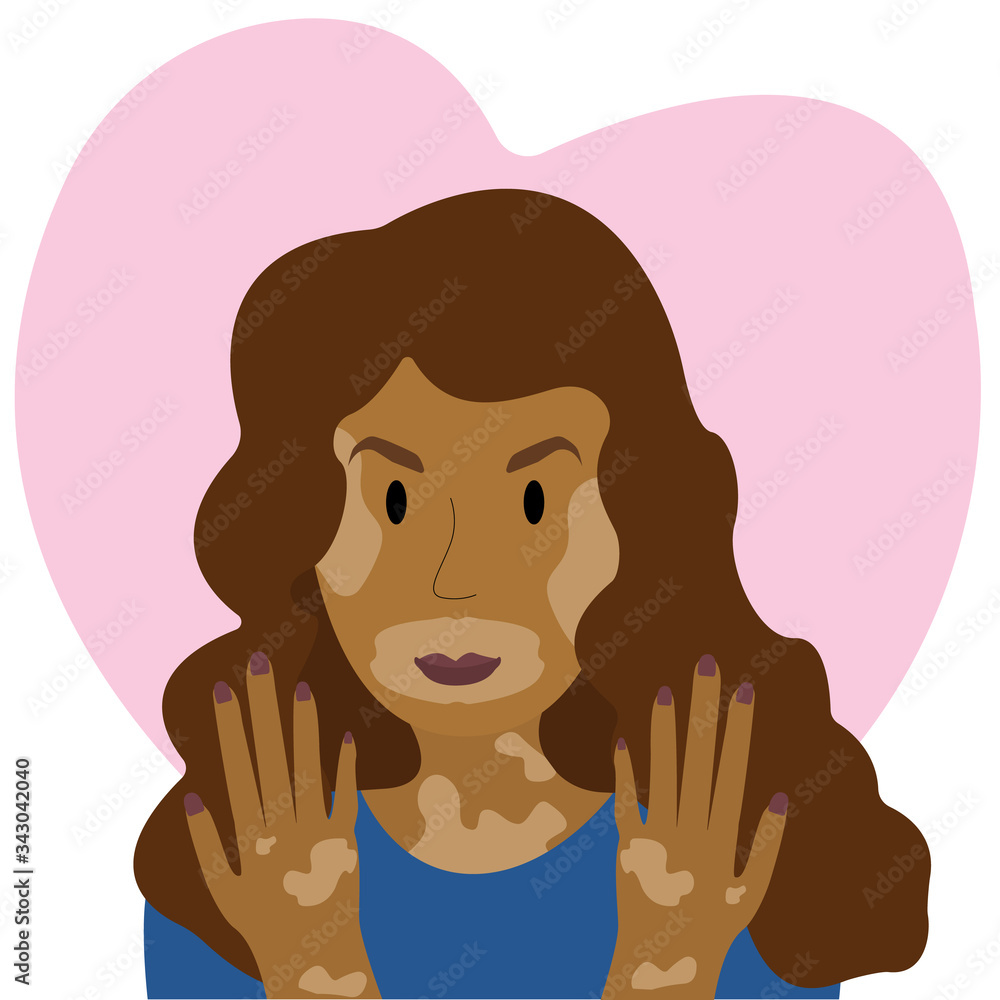 Vector illustration of a woman with vitiligo. Vitiligo skin disease. Love for your skin Vector illustration of a woman with vitiligo. Vitiligo skin disease. Love for your skin