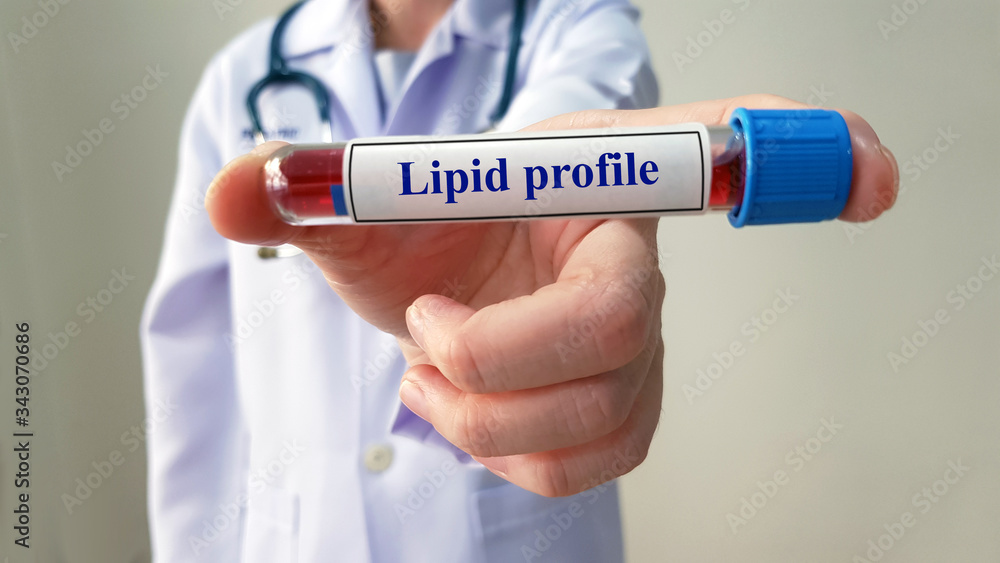 Doctor show laboratory of Lipid profile test for diagnosis