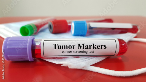 Laboratory sample of Tumor markers test for diagnosis cancer. Cancer test  aim to screening,early detection before spread(metastasis).  Malignancy oncology investigation and medical technology concept