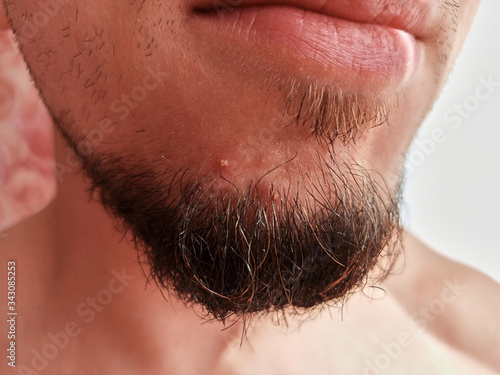 a young man with a pimple in his beard photo