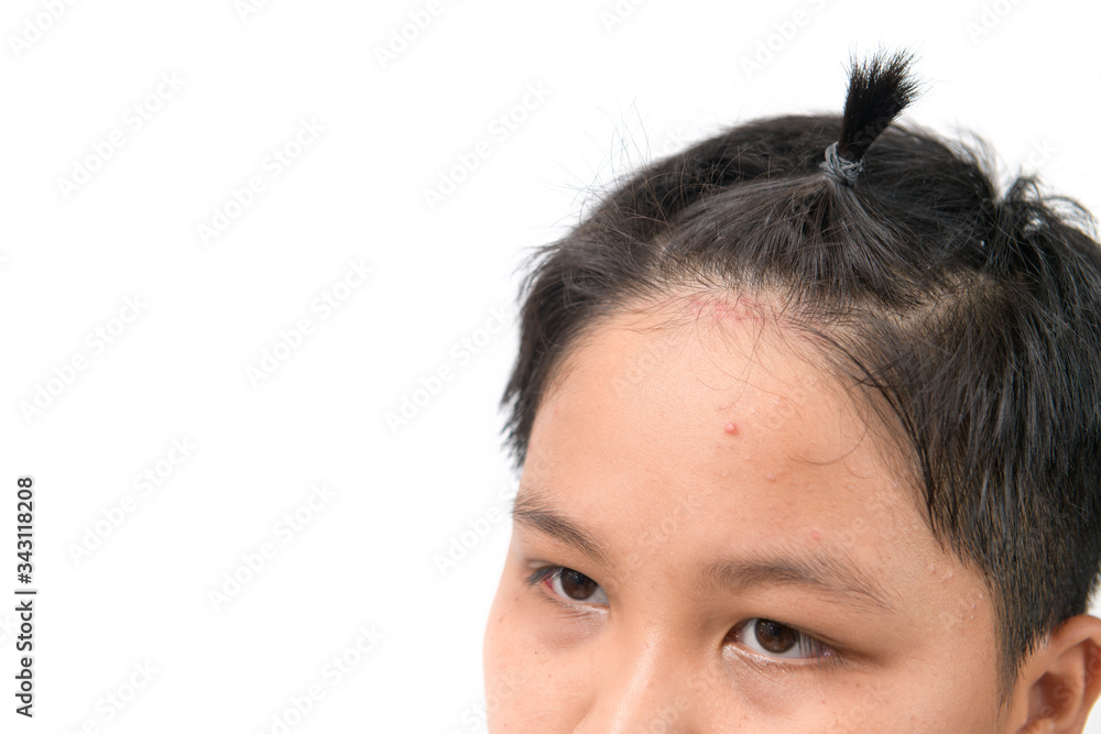Skin rash and acne on forehead boy isoalted on white Skin rash and acne on forehead boy isoalted on white