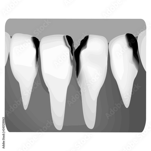 Dental caries. X-ray of tooth decay. Caries infographics. Vector illustration on isolated background.