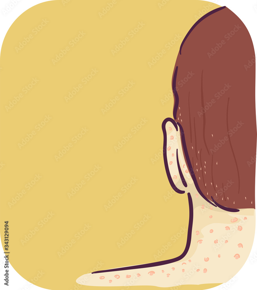 Symptom Head Neck Red Bump Lice Bites Illustration Stock Vector Adobe