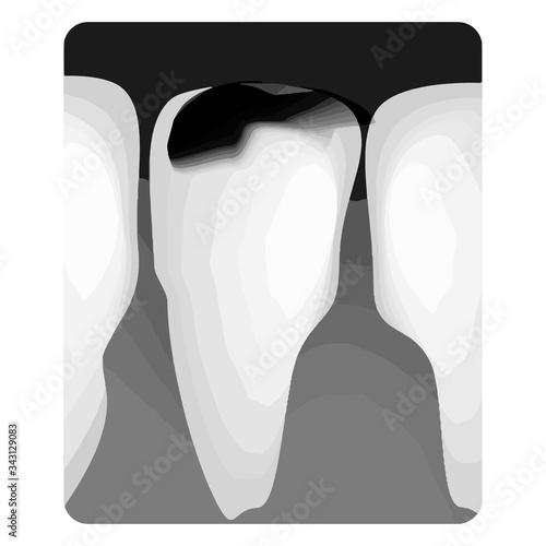 Dental caries. X-ray of tooth decay. Caries infographics. Vector illustration on isolated background.