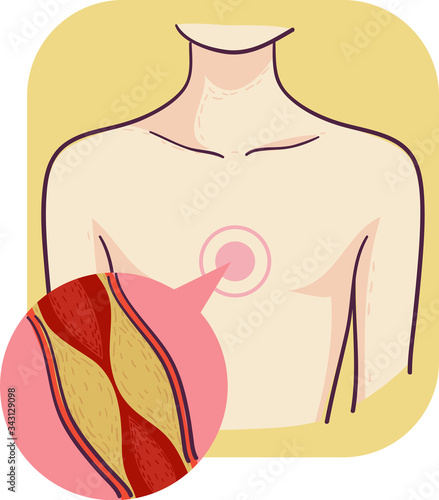 Heart Coronary Artery Bypass Plaque Illustration
