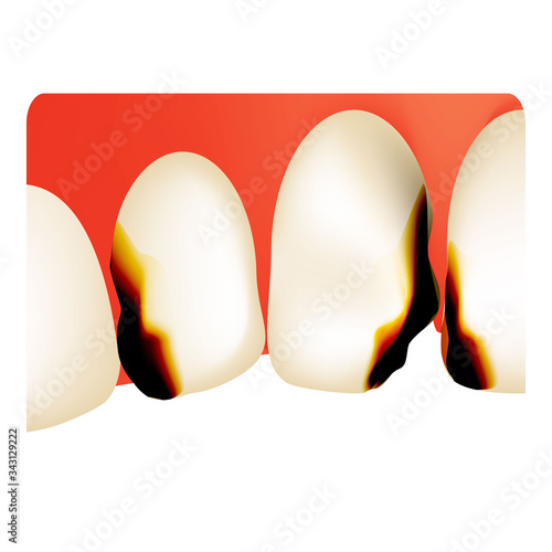 Dental caries. tooth decay. Caries infographics. Vector illustration on isolated background.