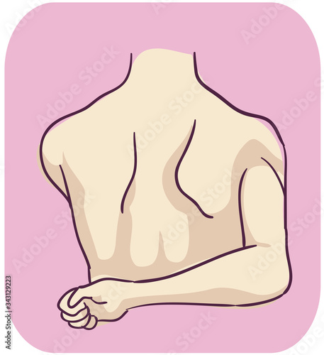 Symptom Winged Scapula Illustration