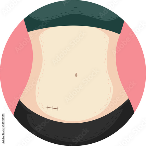 Appendectomy Surgery Stitches Illustration