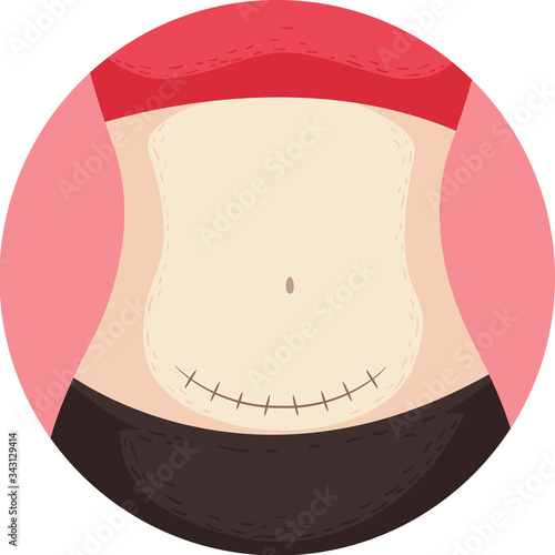 Cesarean Section Surgery Stitches Illustration
