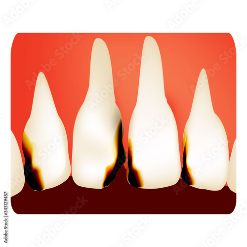 Dental caries. tooth decay. Caries infographics. Vector illustration on isolated background.
