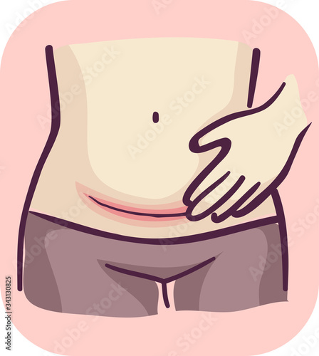 Symptom Redness Cesarean Wound Illustration