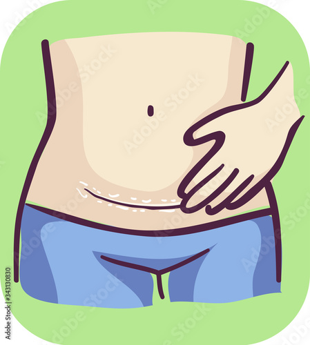 Symptom Sweaty Cesarean Wound Illustration