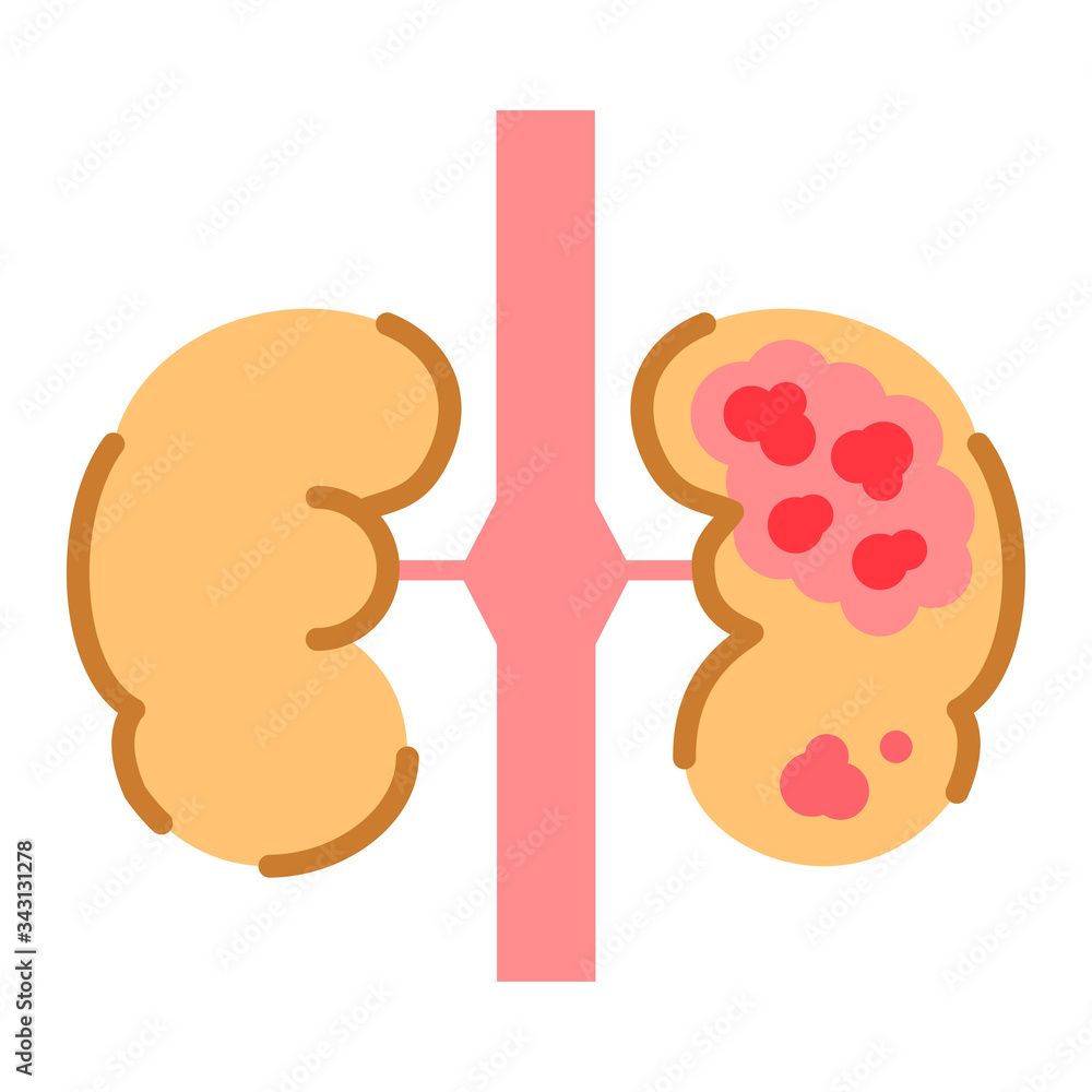 kidney-cancer-line-color-icon-human-organ-concept-malignant-neoplasm