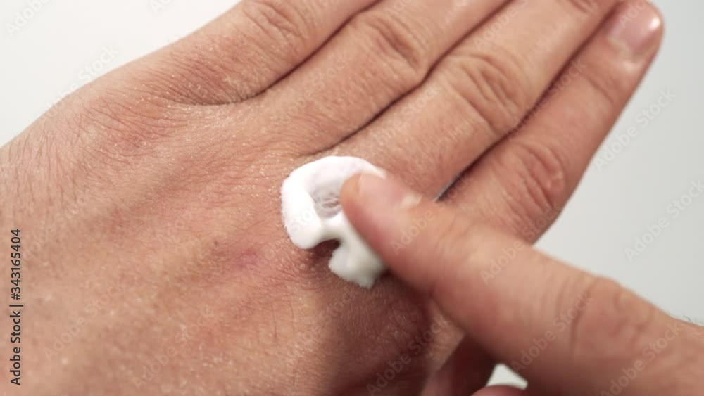 Closeup of a Caucasian man moisturizing his hands with extremely dry and cracked skin due to