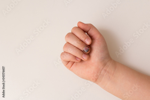 a damaged fingernail on the hand injury