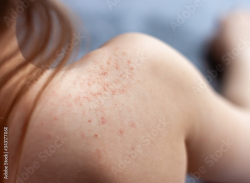 The shoulder of a child with red spots signs of dermatitis.