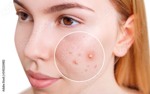 Young blond woman with zoom circle before and after acne treatment.