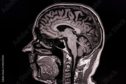 Obraz na plátně MRT images of a human head