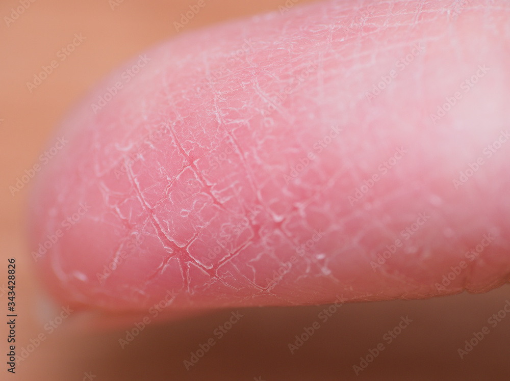 Fototapeta premium broken finger skin during winter
