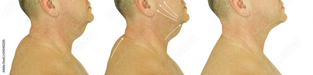 Fototapeta premium male double chin before and after treatment