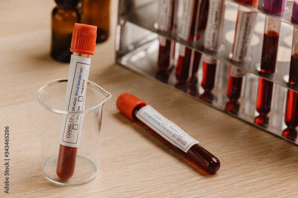 COVID-19 test and laboratory sample of blood testing for diagnosis new Corona virus infection(novel corona virus disease 2019)from Wuhan with laboratory background. Pandemic infectious concept COVID-19 test and laboratory sample of blood testing for diagnosis new Corona virus infection(novel corona virus disease 2019)from Wuhan with laboratory background. Pandemic infectious concept