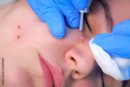 Surgeon removing mole using laser on woman face, burning skin, beauty treatment, closeup view. Cosmetic treatment in beauty clinic. One day surgery concept. Removing birthmark surgical procedure.