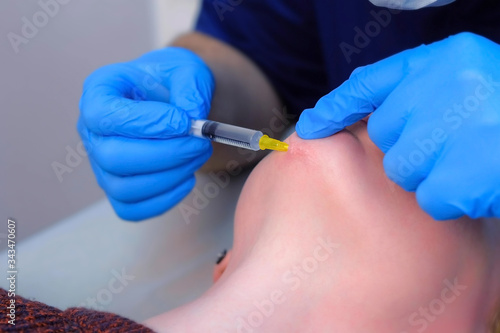 Doctor surgeon making anesthesia injection on woman's face before laser removal of scar on chin, face closeup. cosmetic treatment in beauty clinic. One day surgery concept. Remove surgical procedure.