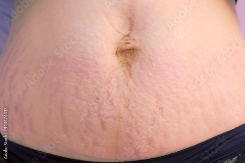 Woman's abdomen after childbirth and pregnancy, skin with heavy stretches, closeup view. Postpartum recovery concept. Before carboxytherapy treatment and remove of skin tags and stretches in clinic.