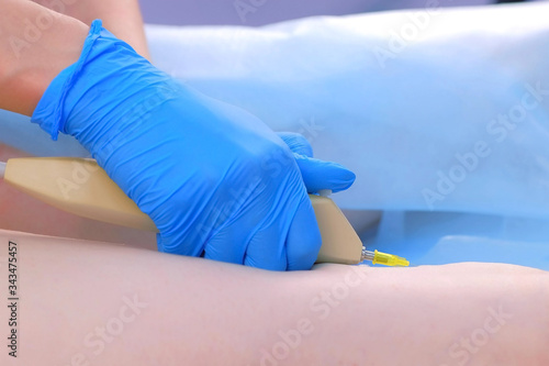 Doctor is making injection of carbon dioxide on patient's leg on carboxytherapy, body closeup. Cosmetologist woman using special apparatus. Treatment and remove of skin tags and stretches.