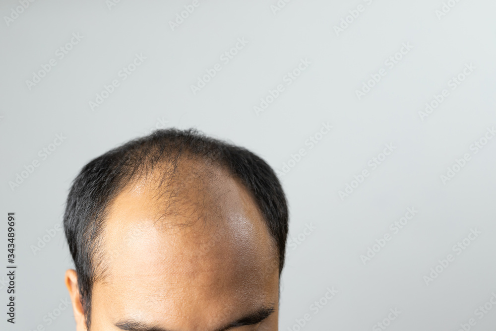 Close up man head of hair loss Close up man head of hair loss