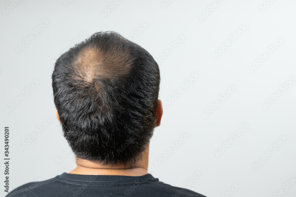 Close up man head of hair loss Close up man head of hair loss