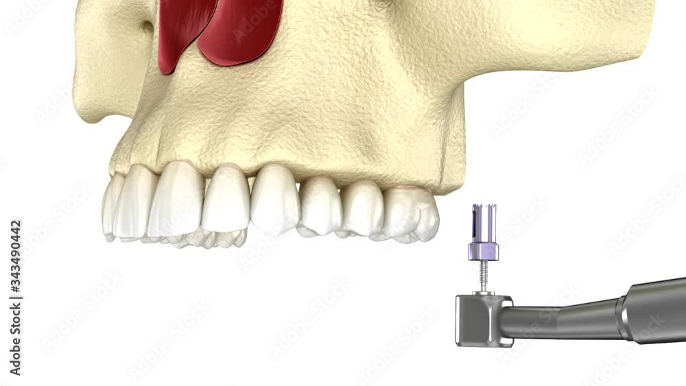 Sinus Lift Surgery with frontal access. 3D animation of dental surgery Sinus Lift Surgery with frontal access. 3D animation of dental surgery
