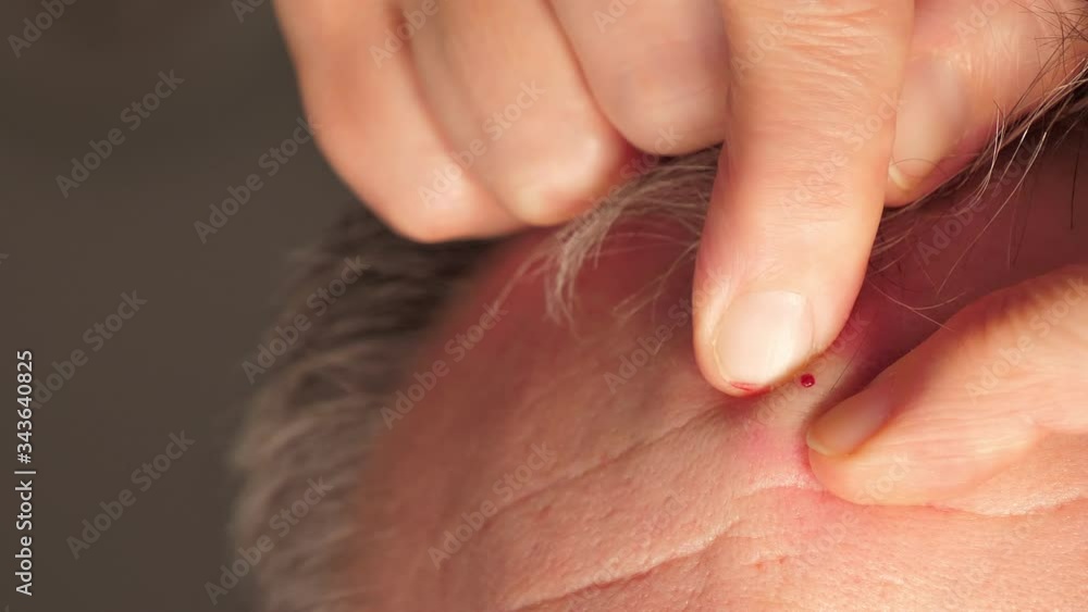 Squeezing out the blood from the pimple on the forehead Squeezing out the blood from the pimple on the forehead