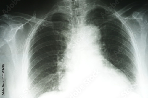 Medical concept: Image of adult x-ray film