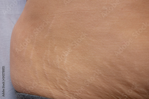 Postnatal changes as stretches on skin. After birth marks on belly of woman. Close-up view of postpartum stretches or age skin recovery