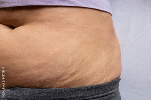 Postnatal changes as stretches on skin. After birth marks on belly of woman. Close-up view of postpartum stretches or age skin recovery