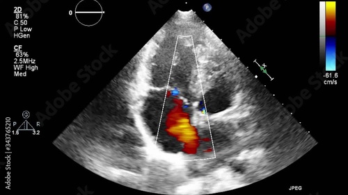 Transesophageal ultrasound video in Doppler mode. photo