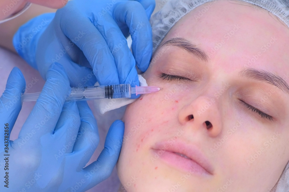 Cosmetologist doctor making multiple injections biorevitalization in woman face skin under eye, portrait closeup. Mesotherapy and face lifting in beauty clinic. Beautician's hands and girl's face. Cosmetologist doctor making multiple injections biorevitalization in woman face skin under eye, portrait closeup. Mesotherapy and face lifting in beauty clinic. Beautician's hands and girl's face.