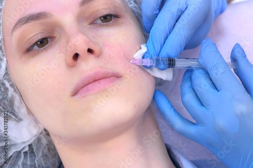 Doctor's cosmetologist hands in gloves making multiple injections in woman's face skin during mesotherapy in cosmetology. Biorevitalization and face lifting in beauty clinic. Closeup girl's portrait.