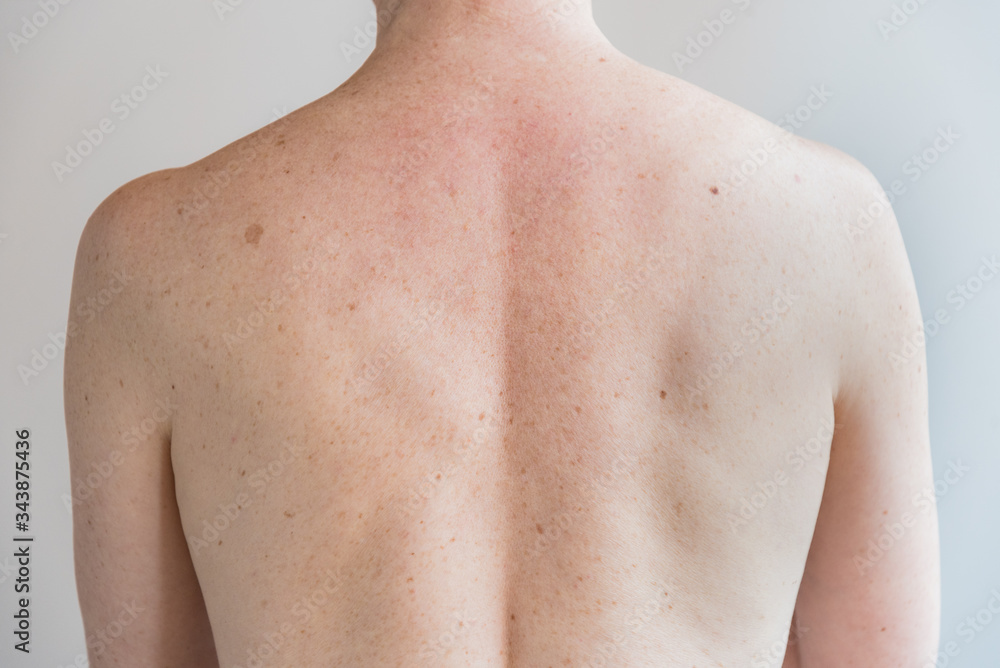 Back with a lot of moles and freckles. Concept of health. Examination by a doctor. Back with a lot of moles and freckles. Concept of health. Examination by a doctor.