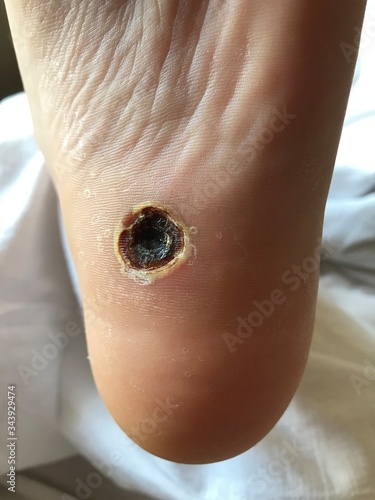 A foot wound and problem skin