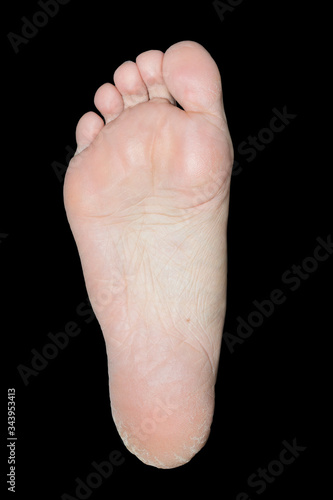 dry dehydrated skin on the heels of female legs, isolated on a black background