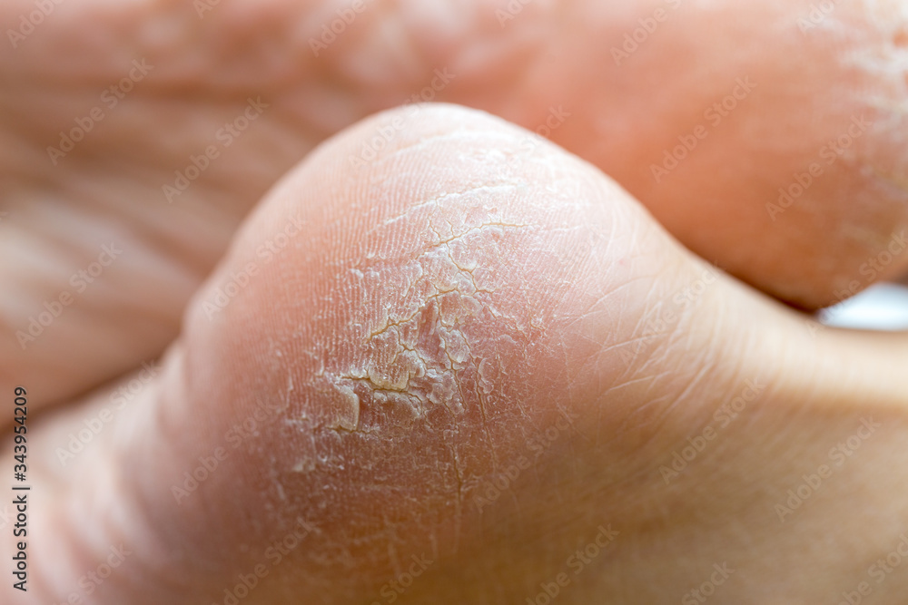 dry dehydrated skin on the heels of female legs dry dehydrated skin on the heels of female legs