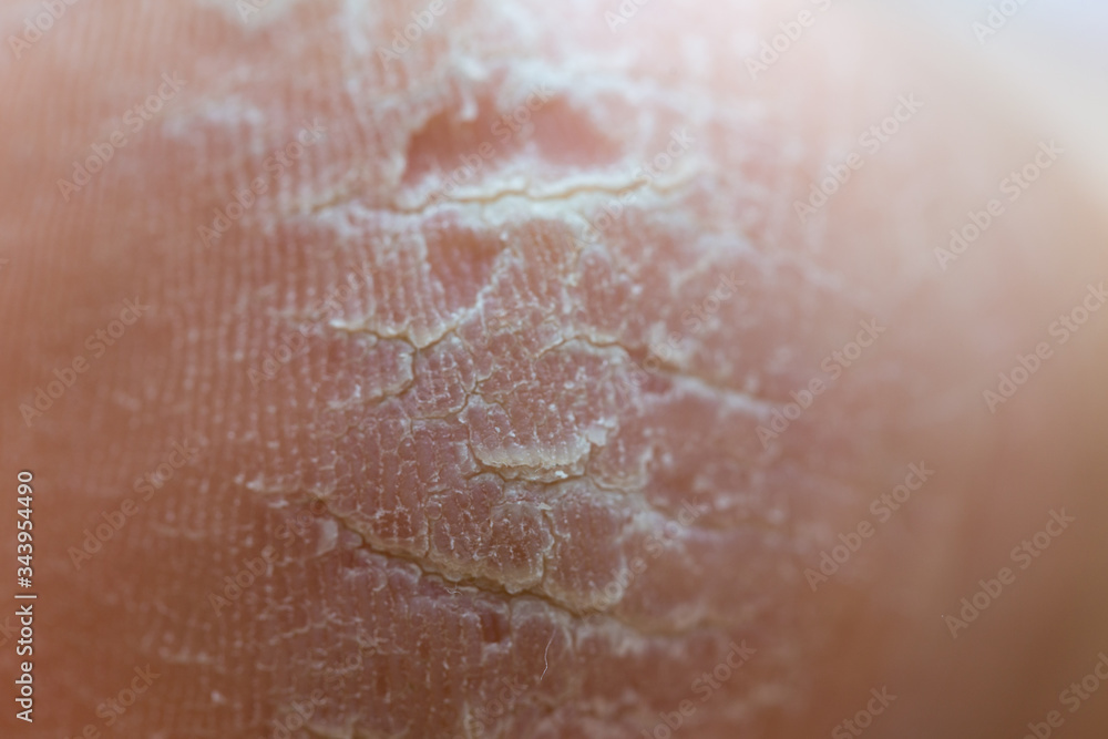 dry dehydrated skin on the heels of female legs dry dehydrated skin on the heels of female legs