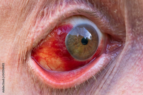 Subconjunctival Hemorrhage (Bleeding) of the Sclera (eye) photo